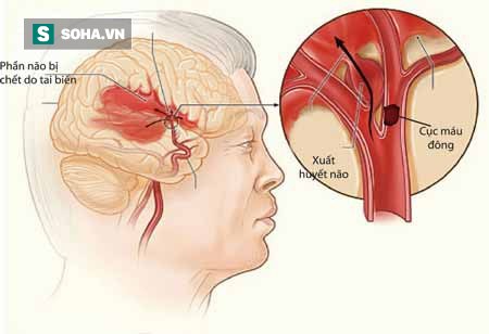 Chuyên gia tim mạch: Nhiều trường hợp bị nguy hiểm vì uống An cung ngưu hoàn phòng đột quỵ - Ảnh 2.