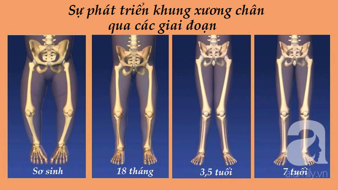 Liệu có thực sự đáng lo ngại nếu bố mẹ phát hiện con bị chân cong vòng kiềng? - Ảnh 3.