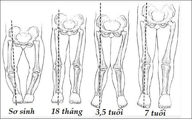 Liệu có thực sự đáng lo ngại nếu bố mẹ phát hiện con bị chân cong vòng kiềng? - Ảnh 4.