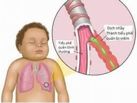  Viêm phổi ở trẻ nhỏ khi thời tiết thất thường - Ảnh 1.