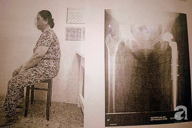 Bằng phương pháp này, bác sĩ Việt giúp người phụ nữ mang khối bướu ác tính ở xương đùi không phải tháo khớp - Ảnh 3.