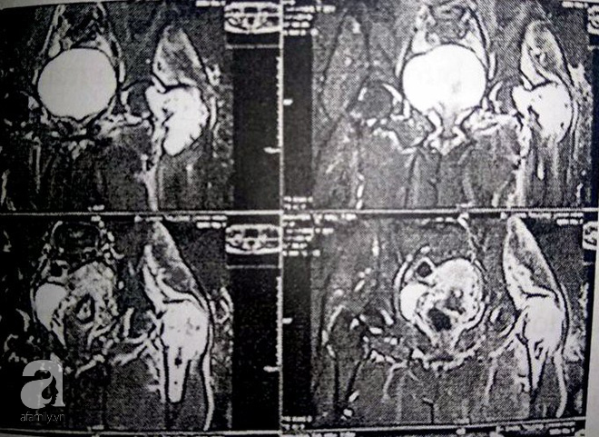 Bằng phương pháp này, bác sĩ Việt giúp người phụ nữ mang khối bướu ác tính ở xương đùi không phải tháo khớp - Ảnh 1.