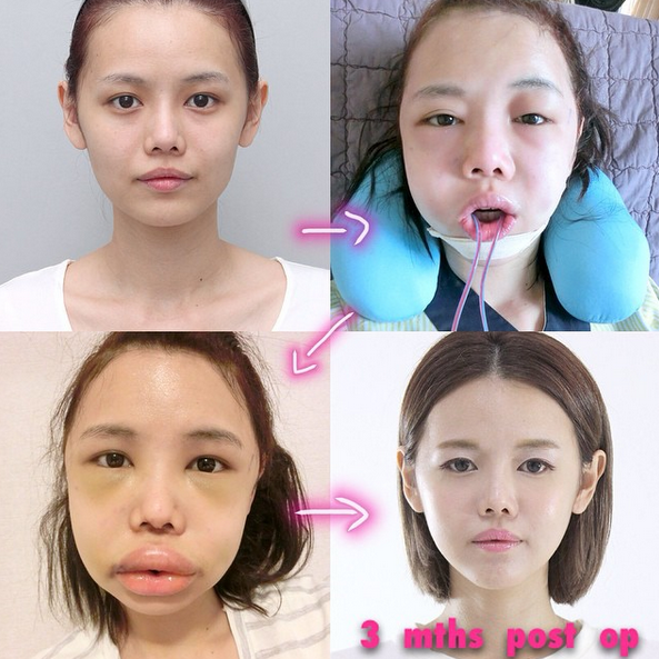 Từng 7 lần dao kéo liên tiếp trong một năm, nhan sắc của bà mẹ 2 con nghiện thẩm mỹ hiện tại trông ra sao - Ảnh 2.