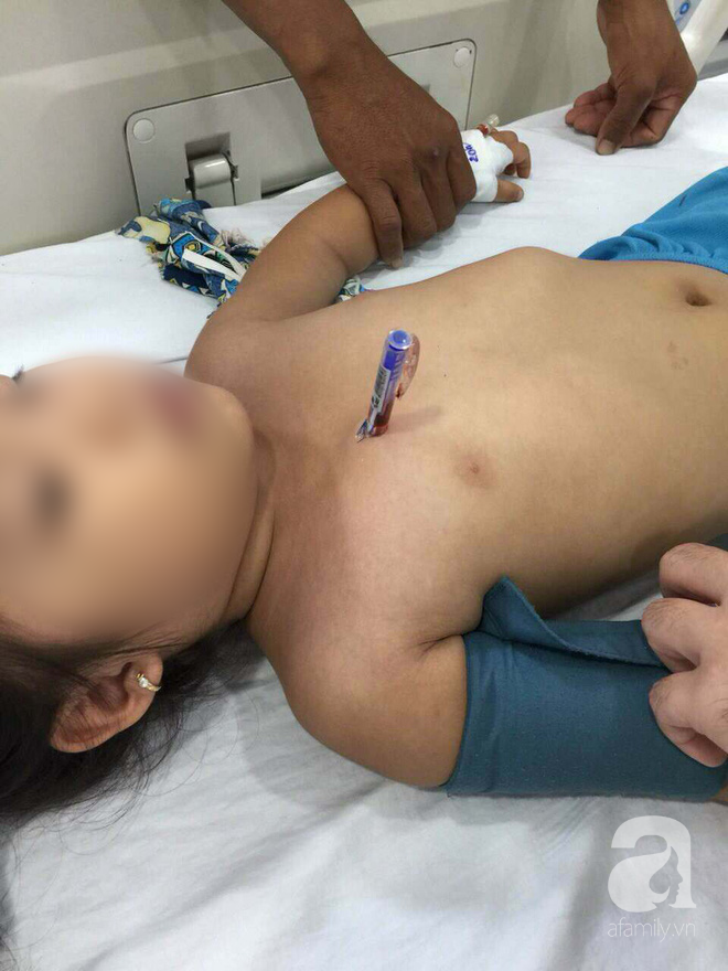 Cầm bút bi chạy chơi, bé gái 4 tuổi bị bút đâm xuyên thấu ngực - Ảnh 1.