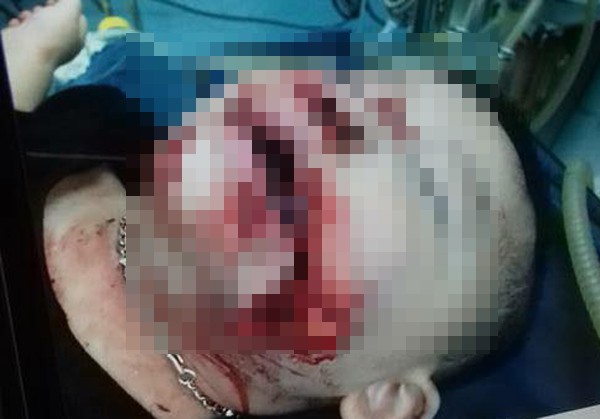 Bác sĩ kể lại 3 giờ cứu sống em bé 2 tuổi bị chó cắn nát mặt tại Hà Nội - Ảnh 1.