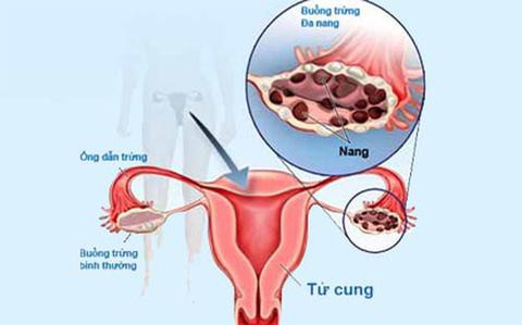 Làm thế nào để biết bạn bị buồng trứng đa nang, lạc nội mạc tử cung? - Ảnh 3.