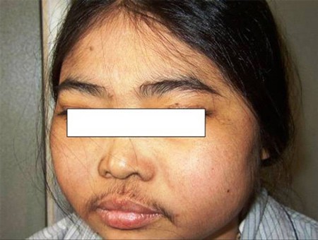 Uống thần dược chữa ho, bé 5 tuổi ở Sơn La bị lông mọc khắp mặt - Ảnh 2.