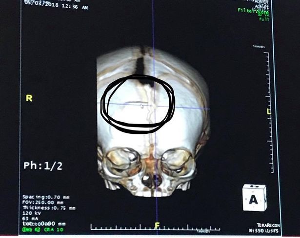 Mẹ bế con gái 7 tuần tuổi đi xem bố đánh bóng chày không ngờ chỉ sau một cú ném bóng, con nhập viện trong nguy kịch - Ảnh 4.