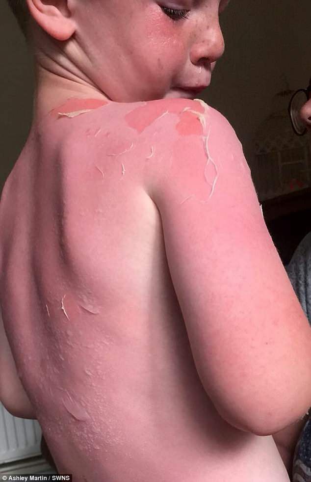 Bôi kem chống nắng để con trai ra ngoài chơi, chỉ 2 tiếng sau ông bố đã thấy con hét thất thanh chạy vào với cả tấm lưng đỏ rực vì bị bỏng - Ảnh 1.