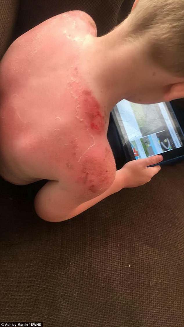 Bôi kem chống nắng để con trai ra ngoài chơi, chỉ 2 tiếng sau ông bố đã thấy con hét thất thanh chạy vào với cả tấm lưng đỏ rực vì bị bỏng - Ảnh 4.