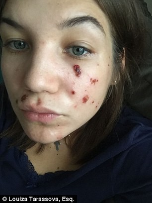 Lột da bằng hóa chất, người phụ nữ đau đớn mang về một gương mặt đầy vết bỏng rộp và nhiễm trùng đáng sợ - Ảnh 3.