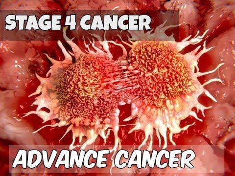 Clip cho thấy ung thư di căn phát triển như thế nào và phá hủy cơ thể người bệnh ra sao - Ảnh 4.