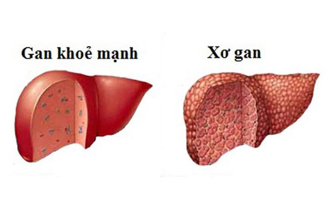 Bỏ túi danh sách thực phẩm ngăn ngừa xơ gan tốt nhất - Ảnh 2.