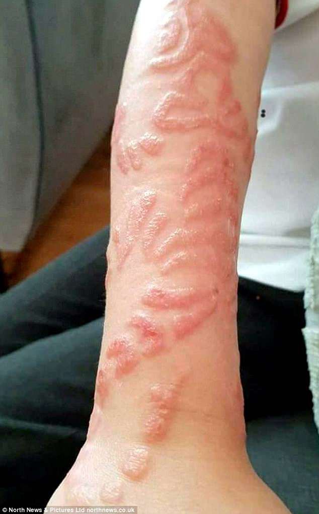 Hai đứa trẻ đau đớn khi tay, lưng sưng tấy do vẽ henna trong chuyến du lịch và lời cảnh báo nhiều phụ huynh bỏ qua - Ảnh 4.