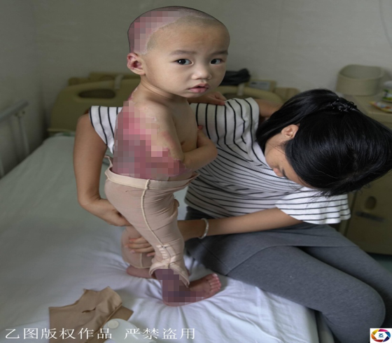 Trung Quốc: Hoàn cảnh thương tâm của bé trai 17 tháng tuổi bị bỏng toàn thân do một phút bất cẩn của bà - Ảnh 6.