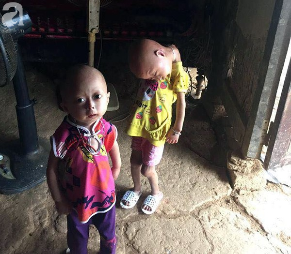 Niềm vui, niềm hi vọng lóe sáng đến với 2 bé gái bị nghẹo đầu tựa người ngoài hành tinh ở Tuyên Quang - Ảnh 1.