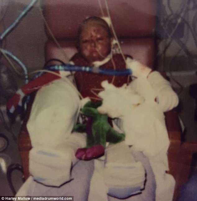 2 tuổi đã bị bỏng toàn thân vì máy giặt phát nổ, hơn 20 năm sau ai cũng bất ngờ khi nhìn thấy dáng vẻ của người phụ nữ ấy - Ảnh 3.