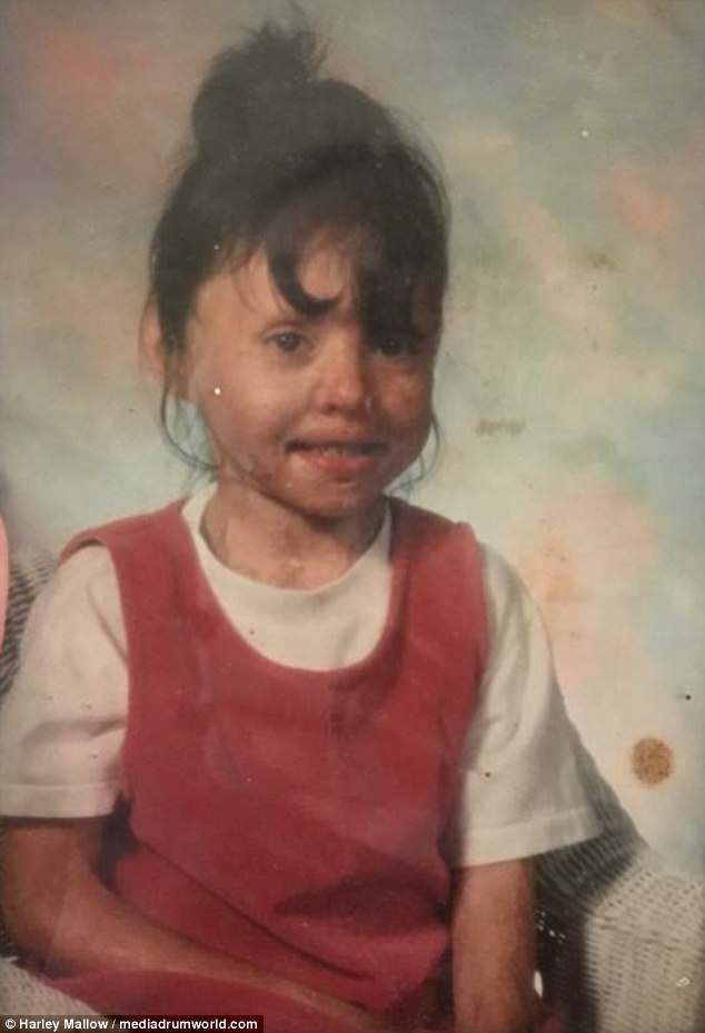 2 tuổi đã bị bỏng toàn thân vì máy giặt phát nổ, hơn 20 năm sau ai cũng bất ngờ khi nhìn thấy dáng vẻ của người phụ nữ ấy - Ảnh 4.