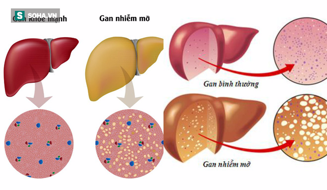 Nguy cơ mắc 1 bệnh đe dọa mạng sống cao gấp đôi nếu bạn để con rơi vào tình trạng này - Ảnh 1.