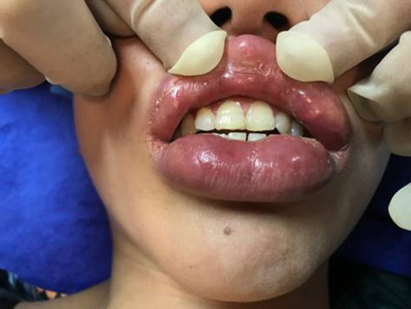 Cô gái trẻ bị biến dạng mắt, môi sau khi tiêm filler tại một thẩm mỹ viện ở Hà Nội - Ảnh 2.