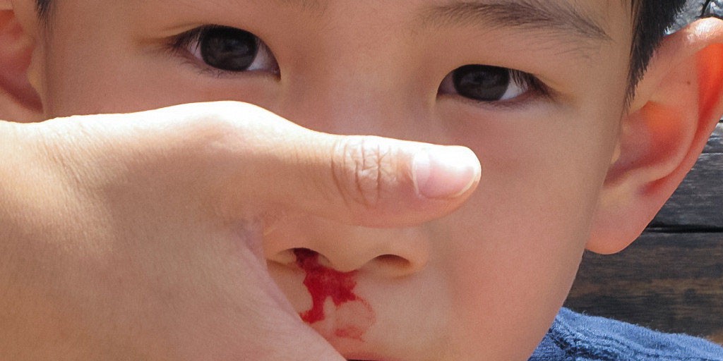 Cảnh báo: Trẻ bị chảy máu cam có thể nguy hiểm tính mạng nếu cứ ngửa đầu ra sau - Ảnh 1.