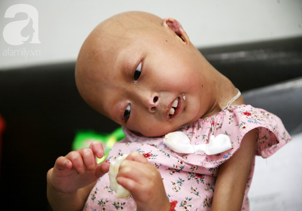 Mẹ của 2 bé gái bị đầu, cổ vẹo lệch ở Tuyên Quang: Giá như con khỏi bệnh, dù đánh đổi gì tôi cũng cam lòng - Ảnh 11.