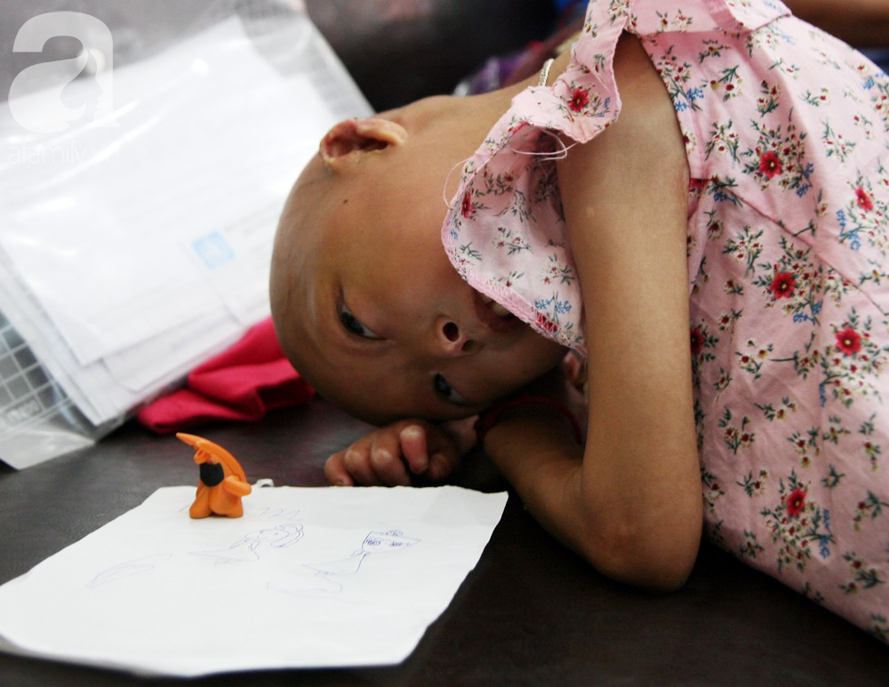 Mẹ của 2 bé gái bị đầu, cổ vẹo lệch ở Tuyên Quang: Giá như con khỏi bệnh, dù đánh đổi gì tôi cũng cam lòng - Ảnh 6.