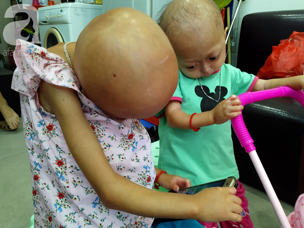 Mẹ của 2 bé gái bị đầu, cổ vẹo lệch ở Tuyên Quang: Giá như con khỏi bệnh, dù đánh đổi gì tôi cũng cam lòng - Ảnh 5.