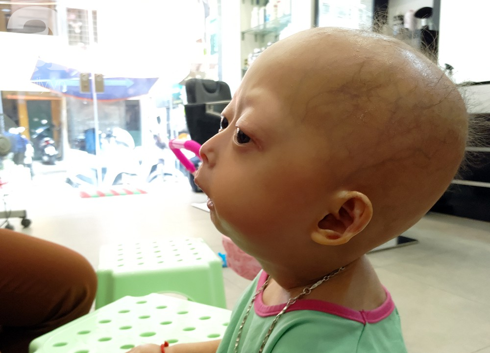 Mẹ của 2 bé gái bị đầu, cổ vẹo lệch ở Tuyên Quang: Giá như con khỏi bệnh, dù đánh đổi gì tôi cũng cam lòng - Ảnh 8.