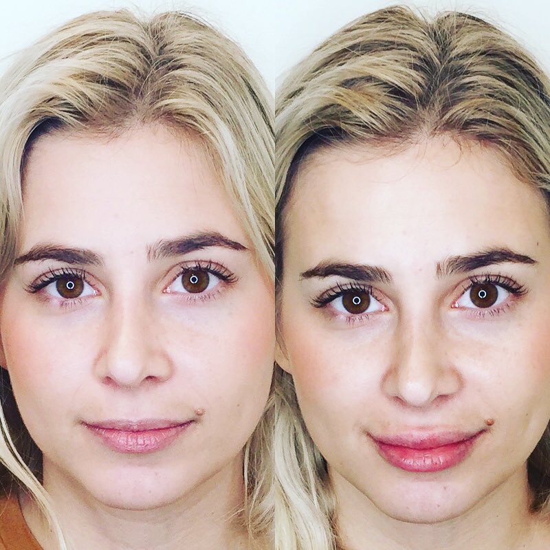 Nếu băn khoăn sau khi rút hết filler, đôi môi có trở lại trạng thái tự nhiên thì đây là câu trả lời của chuyên gia dành cho bạn - Ảnh 2. Nếu băn khoăn sau khi rút hết filler, đôi môi có trở lại trạng thái tự nhiên thì đây là câu trả lời của chuyên gia dành cho bạn - Ảnh 2.