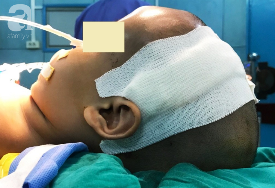 Phẫu thuật cứu bé trai 20 tháng tuổi mang đầu tam giác vì biến dạng hộp sọ - Ảnh 3.
