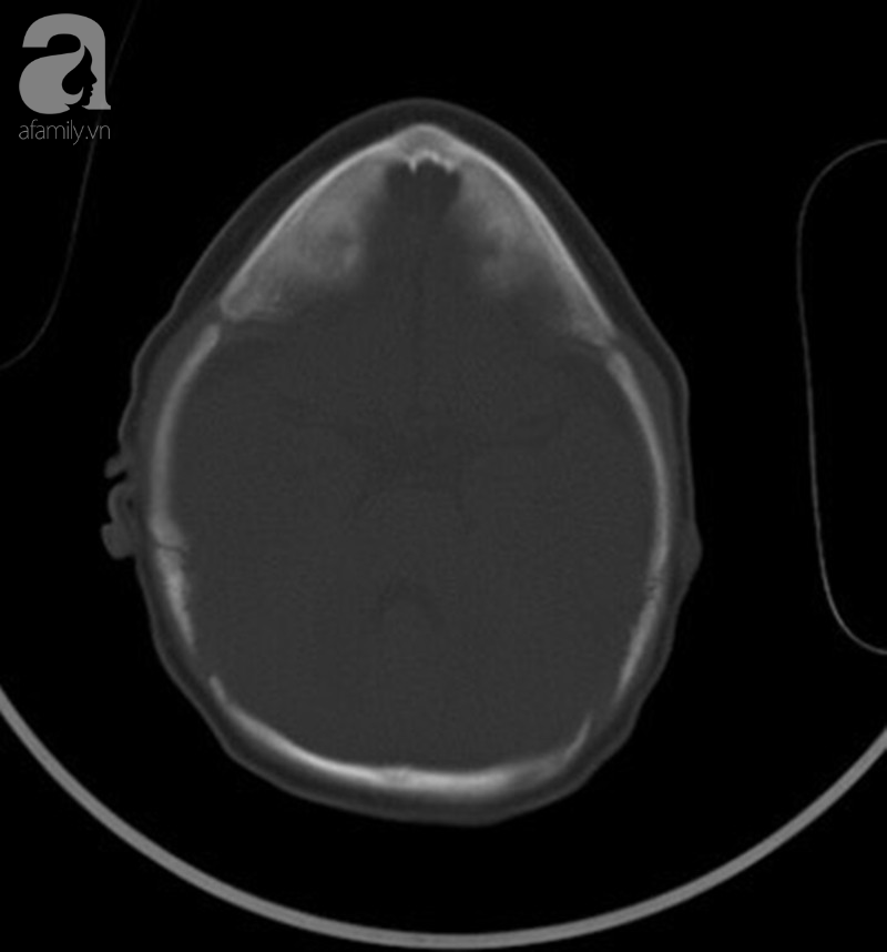 Phẫu thuật cứu bé trai 20 tháng tuổi mang đầu tam giác vì biến dạng hộp sọ - Ảnh 1.