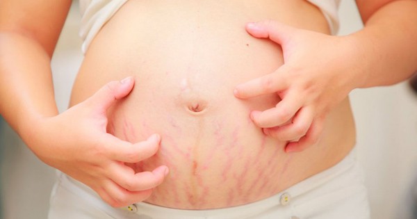 Những thay đổi của làn da khi mang thai, số 1 và số 2 là “kinh khủng” nhất - Ảnh 6.