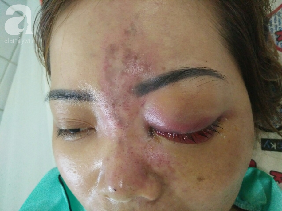 TP.HCM: Người phụ nữ 30 tuổi bị mù hoàn toàn mắt trái vì tiêm filler nâng mũi - Ảnh 1.