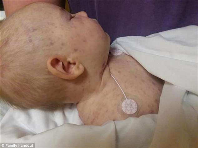 Bé 4 tháng tuổi tử vong do bị viêm màng não sau khi tiếp xúc với một người chưa được tiêm chủng tại nhà trẻ - Ảnh 1.