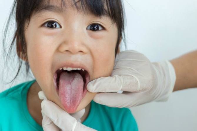 Nếu con bạn có hiện tượng này, có thể bé đã mắc phải bệnh viêm lưỡi bản đồ - Ảnh 2.