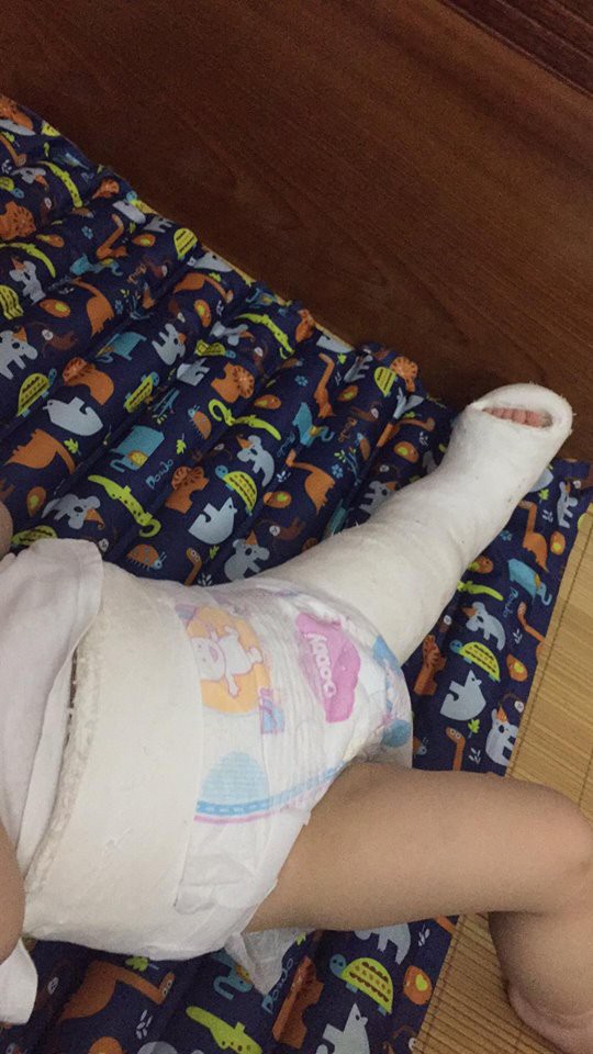 Tưởng chỉ bị đau chân bình thường, ai ngờ bé 10 tháng tuổi mắc phải căn bệnh lạ ở trẻ em - Ảnh 9.