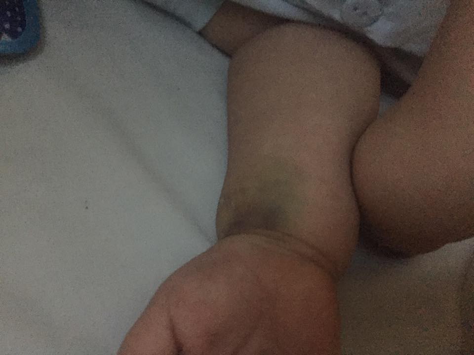 Tưởng chỉ bị đau chân bình thường, ai ngờ bé 10 tháng tuổi mắc phải căn bệnh lạ ở trẻ em - Ảnh 6.