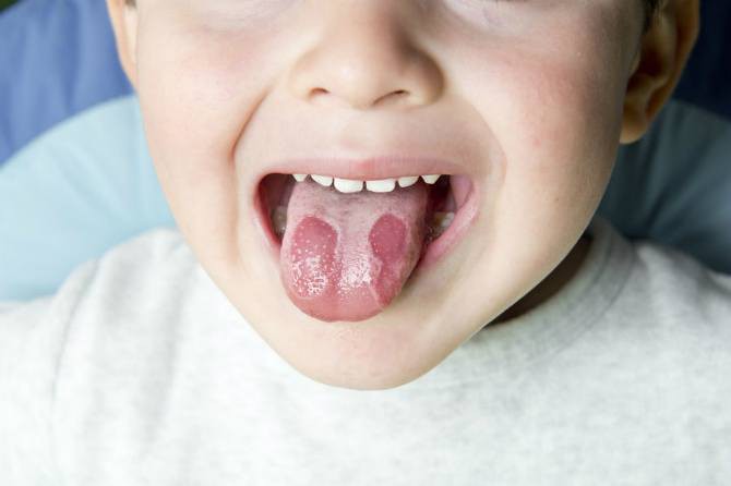 Nếu con bạn có hiện tượng này, có thể bé đã mắc phải bệnh viêm lưỡi bản đồ - Ảnh 1.