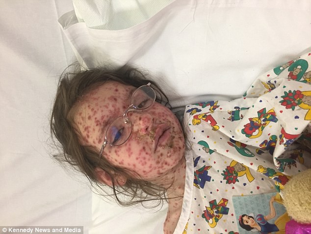 Mắc bệnh thủy đậu khủng khiếp nhất từ trước đến nay, bé 5 tuổi biến dạng cả khuôn mặt - Ảnh 2.