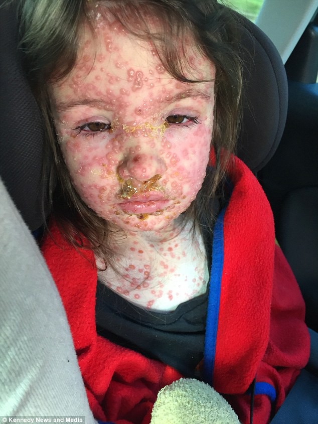 Mắc bệnh thủy đậu khủng khiếp nhất từ trước đến nay, bé 5 tuổi biến dạng cả khuôn mặt - Ảnh 1.