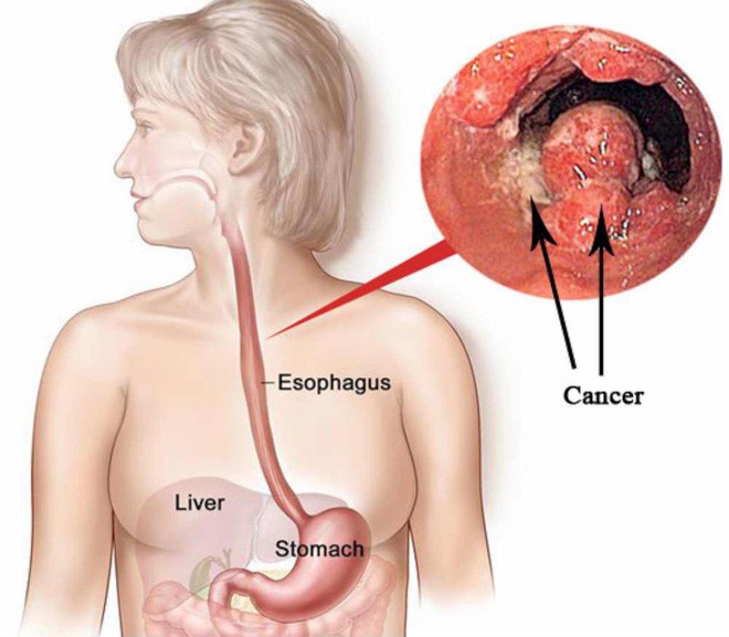 Âm thầm rước án tử vào đường tiêu hóa vì thói quen gần như ai cũng mắc phải - Ảnh 1.