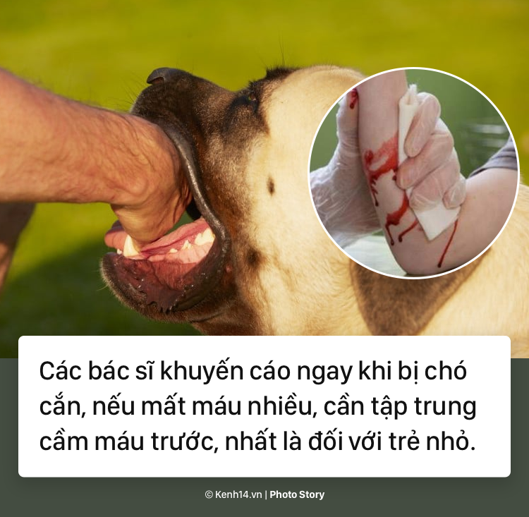 Trước liên tiếp những vụ chó tấn công trẻ em gần đây, tìm hiểu cách sơ cứu vết thương kịp thời - Ảnh 5.