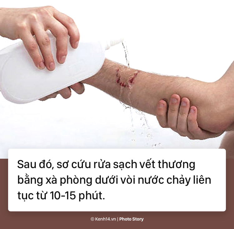 Trước liên tiếp những vụ chó tấn công trẻ em gần đây, tìm hiểu cách sơ cứu vết thương kịp thời - Ảnh 7.