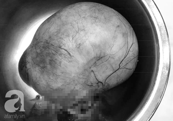Mang chứng bệnh này từ lúc sinh con đầu nhưng chỉ uống thuốc giảm đau, 30 năm sau tính mạng người phụ nữ lâm vào nguy kịch - Ảnh 4. Mang chứng bệnh này từ lúc sinh con đầu nhưng chỉ uống thuốc giảm đau, 30 năm sau tính mạng người phụ nữ lâm vào nguy kịch - Ảnh 4.