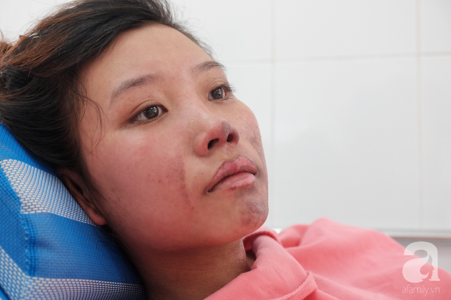 Lên Sài Gòn làm việc phụ mẹ nuôi em, thiếu nữ 18 tuổi bị bình gas mini làm bỏng nặng - Ảnh 1.