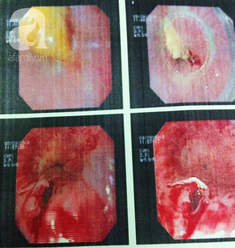 TP.HCM: Mắng con trong lúc ăn phở gà, mẹ bị hóc xương thủng thực quản - Ảnh 2.