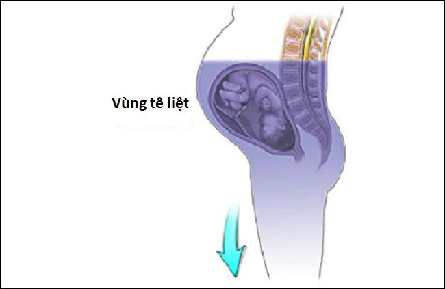 Tất tật những điều các mẹ cần biết về mũi gây tê ngoài màng cứng - phương pháp giảm đau khi sinh nở - Ảnh 2.