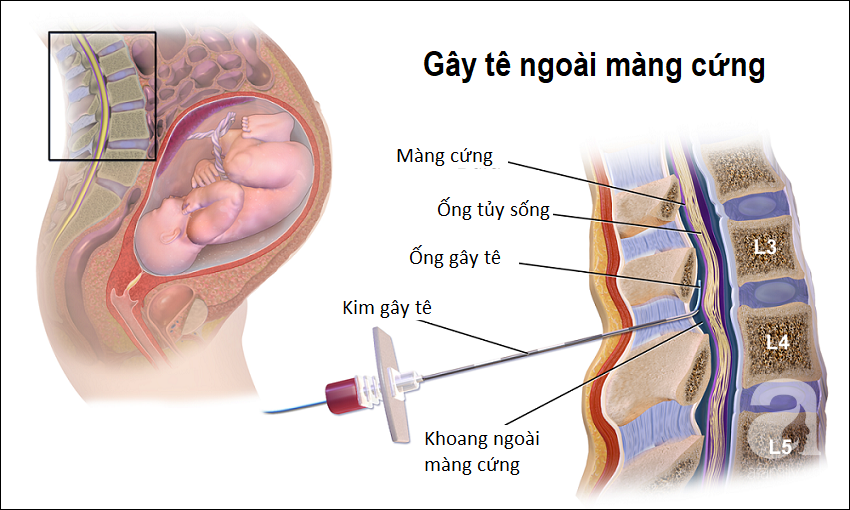 Tất tật những điều các mẹ cần biết về mũi gây tê ngoài màng cứng - phương pháp giảm đau khi sinh nở - Ảnh 3.