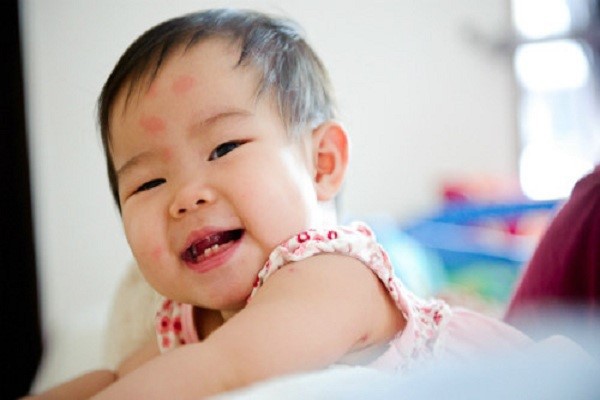 Bác sĩ Nhật gợi ý các cách bảo vệ làn da mỏng manh của trẻ trong mùa hè - Ảnh 2.